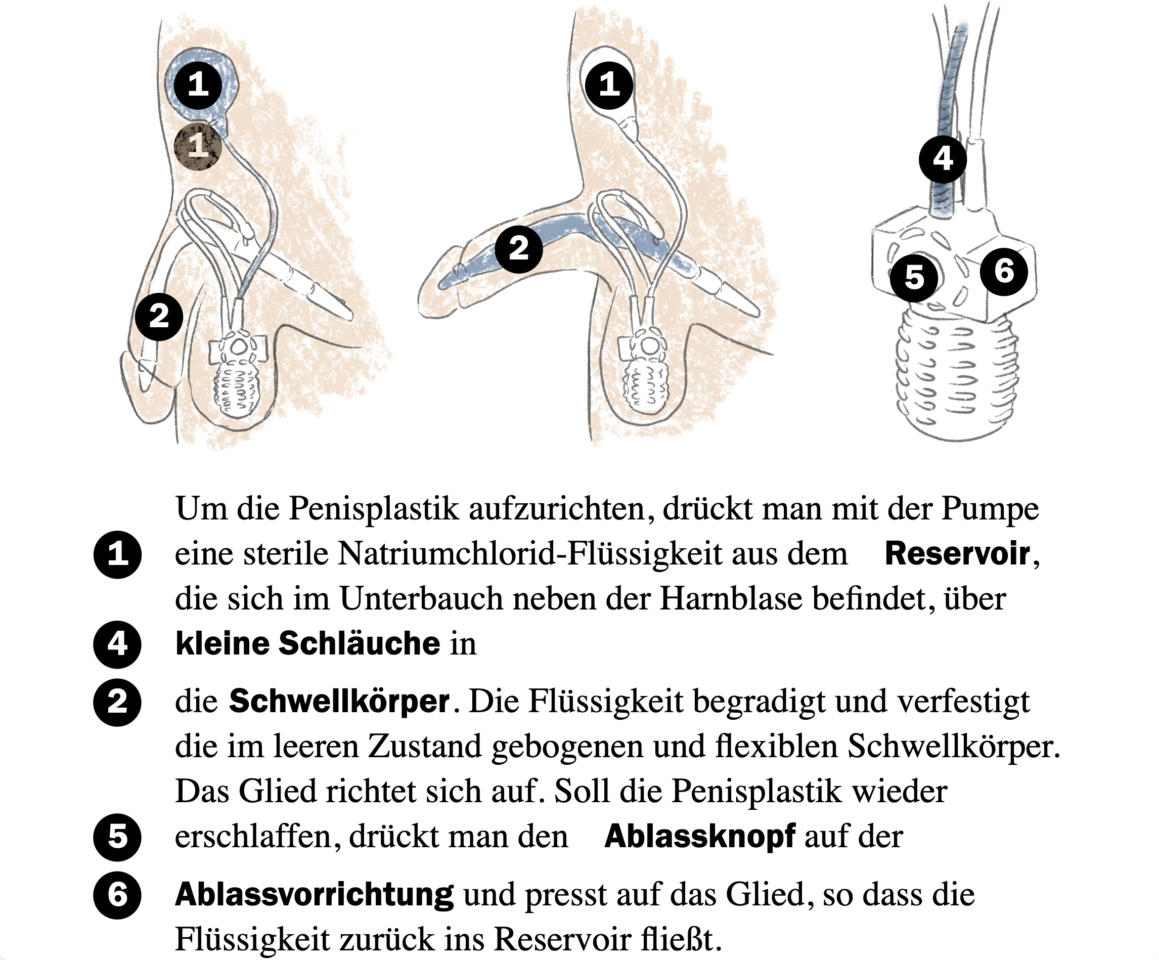 Wie konstruiert man einen Penis, Herr Daverio? Die Haut des Unterarms ist  am besten geeignet | Tagesspiegel