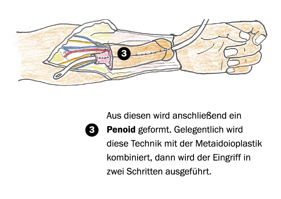 Wie konstruiert man einen Penis, Herr Daverio? Die Haut des Unterarms ist  am besten geeignet | Tagesspiegel
